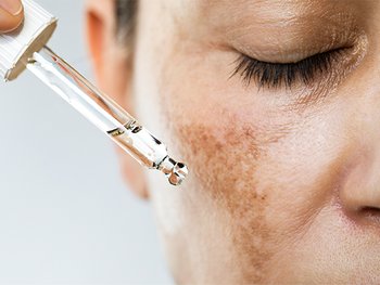 A close-up of a person's eye and cheek, showing a dropper dispensing a clear liquid onto skin that exhibits hyperpigmentation or dark spots.