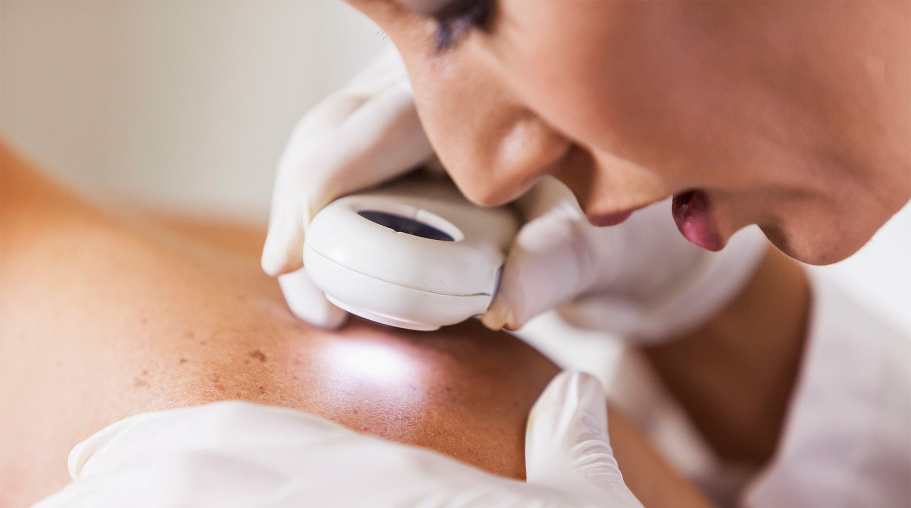A close-up view shows a healthcare professional, wearing white gloves, using a dermatoscopic device to examine moles or skin imperfections on a patient's back. A bright light emanates from the device, illuminating the skin being inspected.