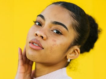 A close-up of a teenage girl with dark skin and dark hair shows acne blemishes on her cheeks and forehead.