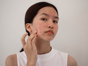Front shot of a young woman touching her face as she observes her dry, blemished skin.