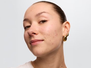 A close-up of a person with some acne.