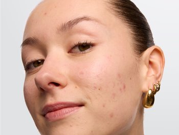 Person with blemishes on their face.