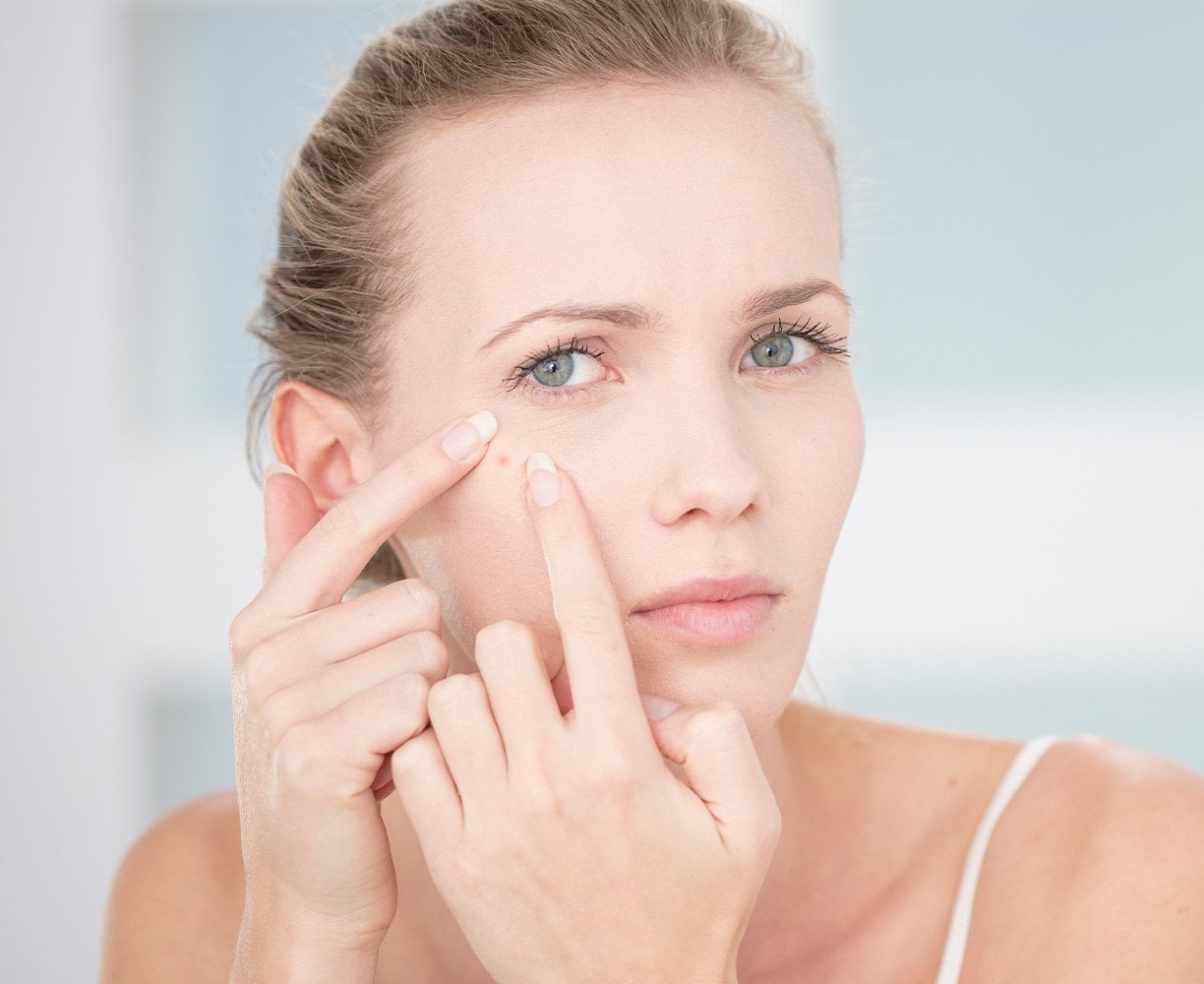 Avoid Picking or Popping Pimples