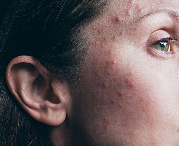Pimples: