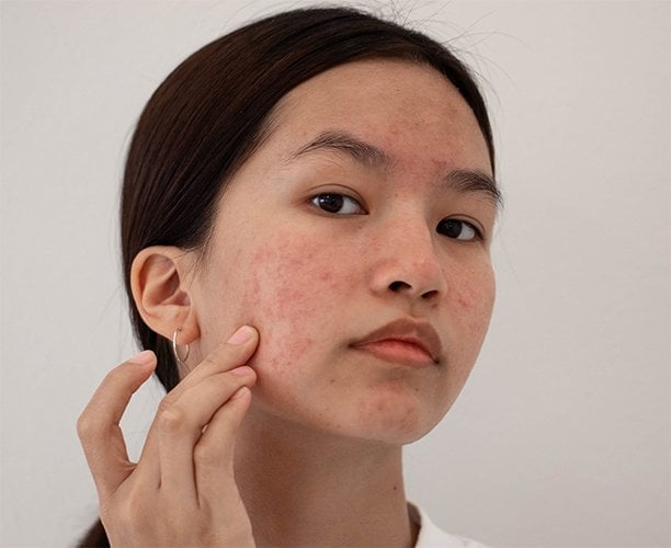 Cystic Acne: